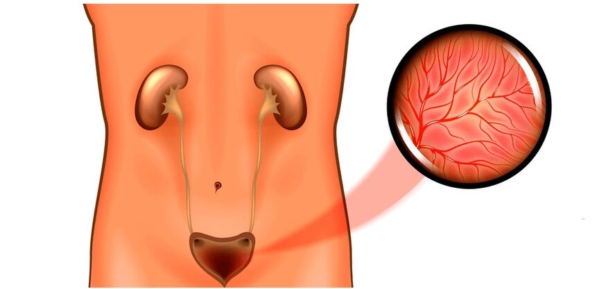 Zystitis bei Männern Symptome und Behandlung